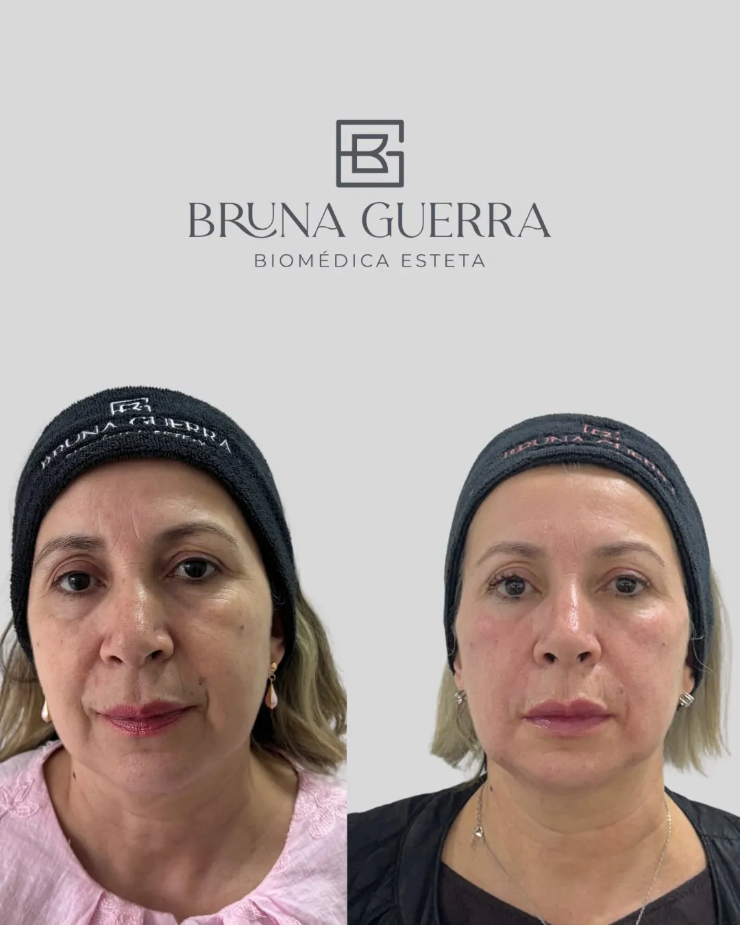 Harmonização Facial - Antes e Depois