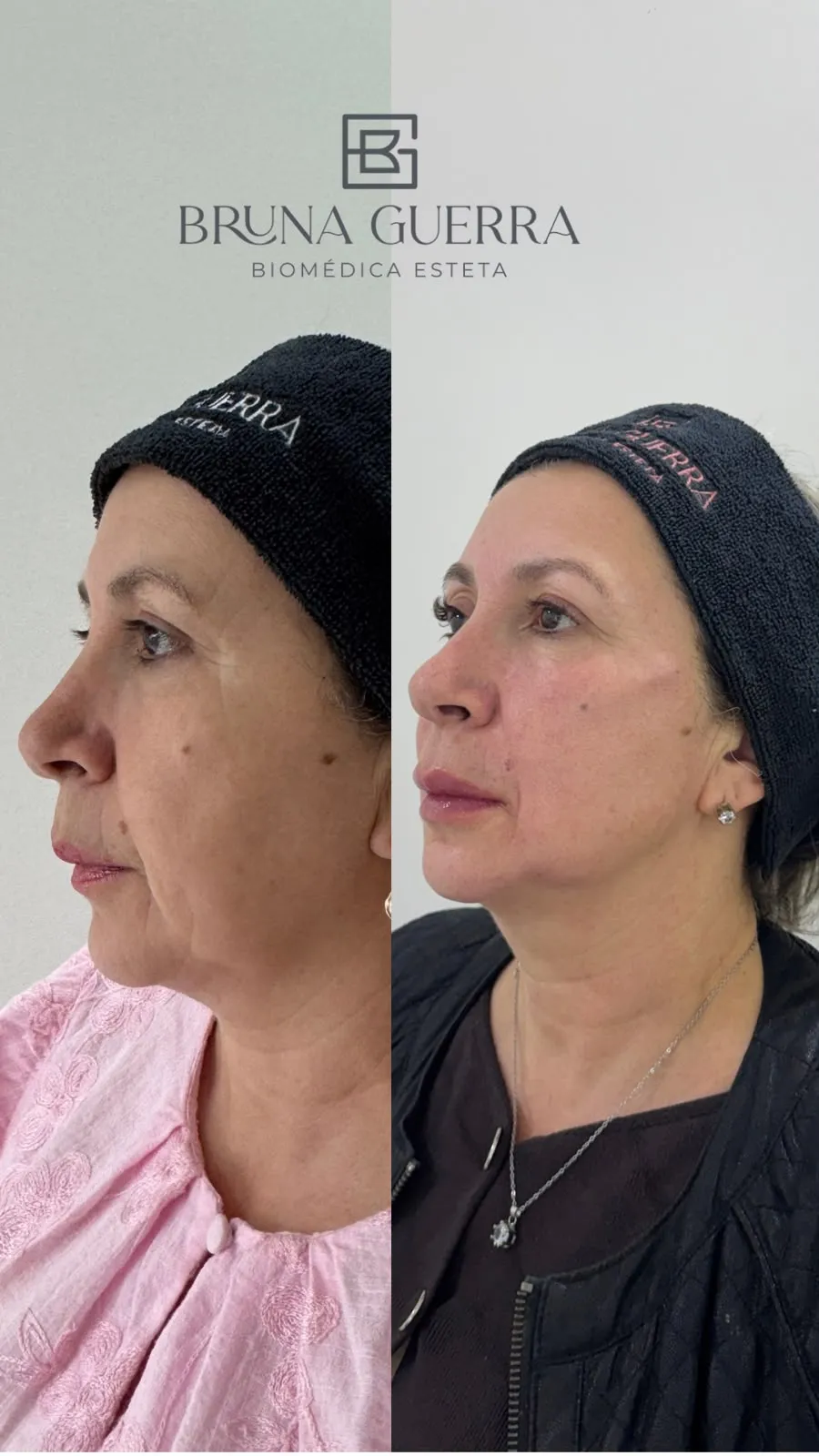Rejuvenescimento Facial - Antes e Depois